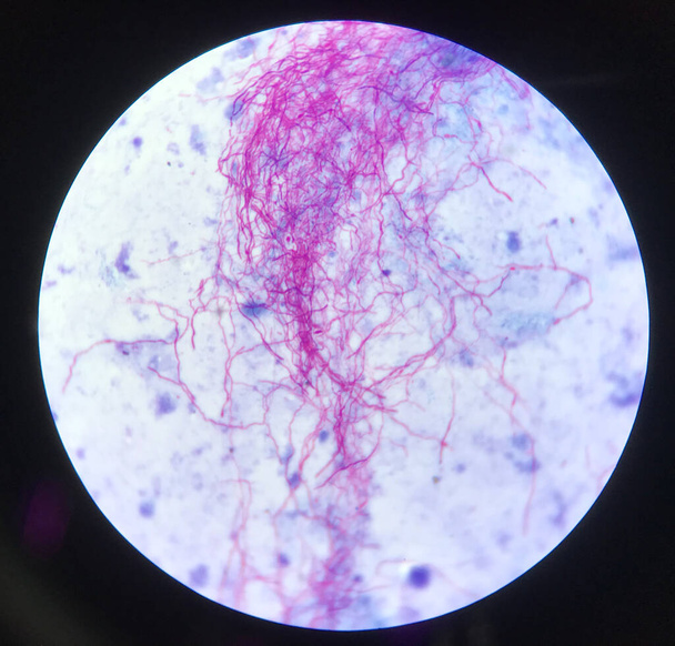 Красный ветвящийся микобактерий туберкулез на синем фоне в модифицированной кислоте быстро окрашивается bacilli stain.finding с микроскопом лабораторный фон
. - Фото, изображение