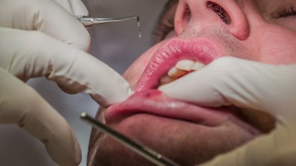 歯医者歯科患者の上部の歯のドリルを開始します - 映像、動画