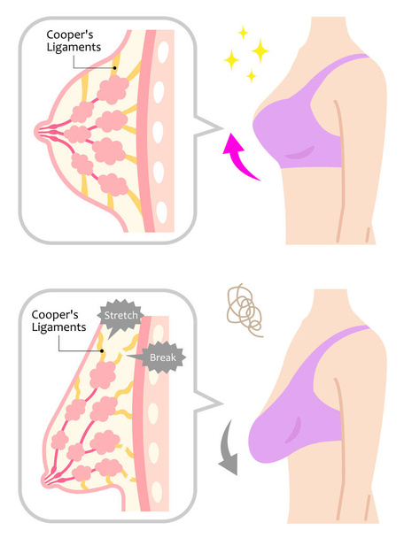 Diagramm einer schlaffen und schönen Brust mit Frauenkörper. davor und danach. Schönheits- und Körperpflegekonzept - Vektor, Bild