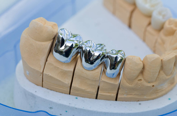 Primo piano della dentizione metallica su un'impronta dentale in un laboratorio odontoiatrico
 - Foto, immagini