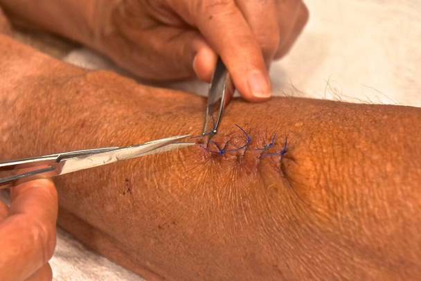 Pincet en schaar worden gebruikt om hechtingen te verwijderen van een pre-kankeroperatie aan een armwond in een been.. - Foto, afbeelding
