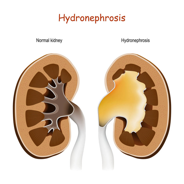Hydronephrosis. Normal kidney and kidney with disorders. dilation of the renal pelvis and calyces as a result of obstruction to urine flow. - Vector, Image