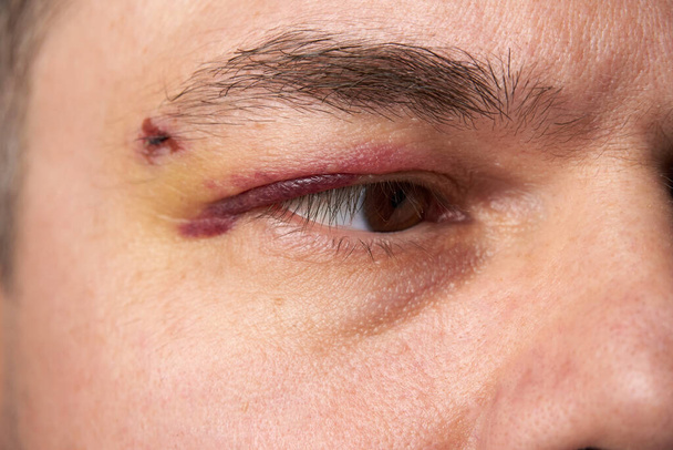 goed zicht op een blauwe plek in de buurt van het oog, het gezicht van een man met een hematoom - Foto, afbeelding