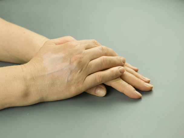 Vitiligo kädet harmaalla pohjalla - Valokuva, kuva