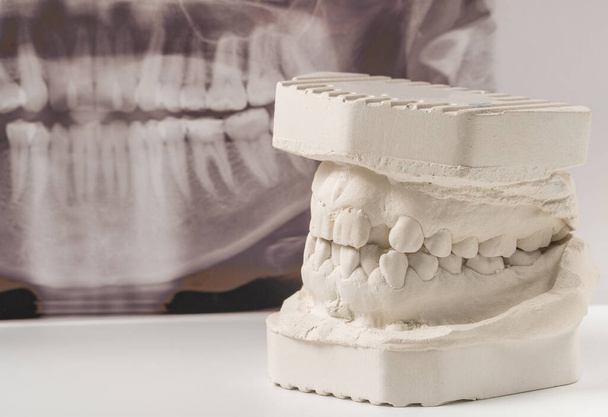 Model gipsu odlewniczego ludzkich szczęk z panoramicznym prześwietleniem zębów. Krzywe zęby i ugryzienie. Strzały padły przed leczeniem aparatem na zęby. Zdjęcia techniczne na szarym tle - Zdjęcie, obraz