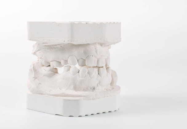 Dental casting gypsum model of human jaws. Crooked teeth and distal bite. Shots were made before treatment with braces . Technical shots on gray background. - Photo, image