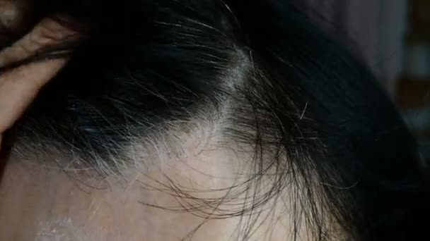 Mujer adulta madura se quita el pelo de la frente. Cabello gris, alopecia y piel problemática en la cabeza. Primer plano. En interiores
. - Imágenes, Vídeo