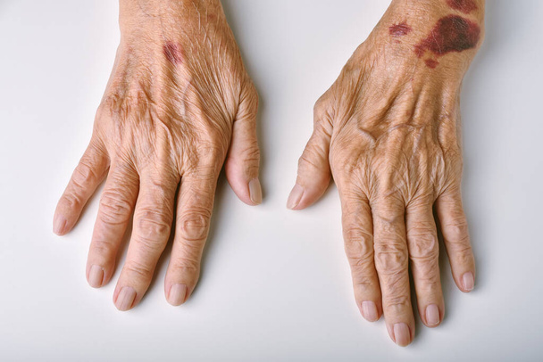 Mains déformées de la vieille femme, Hémorragie cutanée plaie contusionnelle et purpura sénile, Douleur et raideur des doigts dues à l'arthrite chez les personnes âgées, Concept de soins de santé pour personnes âgées
. - Photo, image