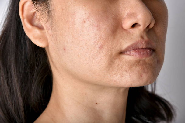 Bőrprobléma akne betegségek, Közelkép az ázsiai nő arcát fehérfejű pattanások, Menstruáció kitörés, Heg és zsíros arc, Szépség koncepció. - Fotó, kép
