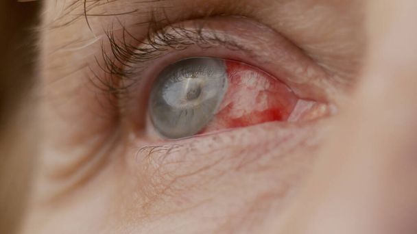 Закрывай. женский глаз с химическими ожогами роговицы. лопнувшие капилляры, операция на катаракте
 - Фото, изображение