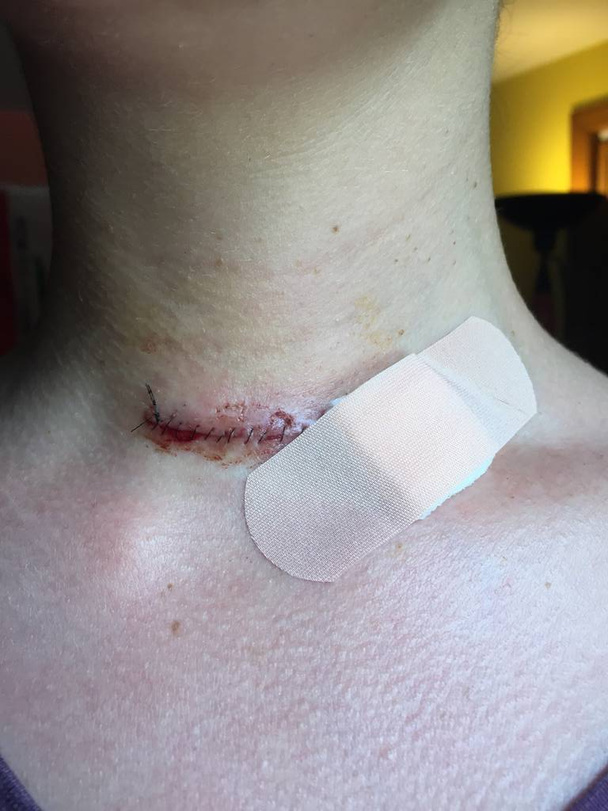 Jizva po tyreoidektomii po operaci v důsledku papilárního karcinomu štítné žlázy se stehy a obvazem pokrývajícím otevřenou ránu z odtoku  - Fotografie, Obrázek