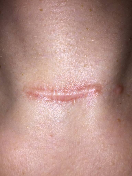 Acercamiento de una cicatriz roja, hipertrófica o queloide elevada en el cuello de una mujer como resultado de una cirugía de tiroidectomía
  - Foto, Imagen
