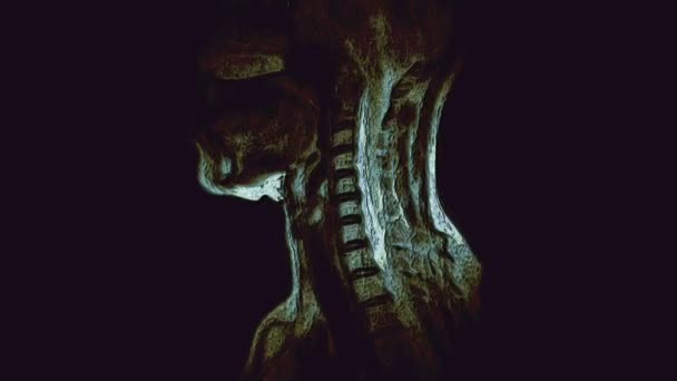 Bulk multicolored MRI of the cervical spine, detection of protrusions and hernias - Footage, Video