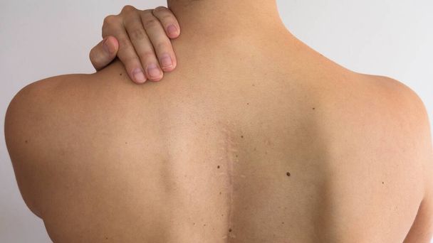 Schmerzen in den Schultern einer Frau, die eine Narbe aus einer Wirbelsäulenoperation hat. - Foto, Bild