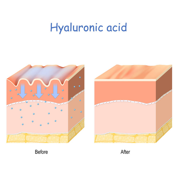 Hyaluronsäure. Hautpflegeprodukte. Hautverjüngung mit Hilfe von Hyaluronsäure. Falten auf der menschlichen Haut. Vor und nach der Verwendung der Hyaluronsäure - Vektor, Bild