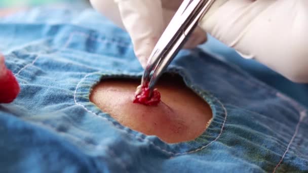 Wyodrębnianie tłuszczaka w plecach człowieka w chirurgii ambulatoryjnej w sposób selektywny - Materiał filmowy, wideo