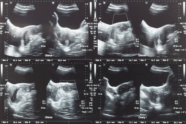 УЗИ нижней части живота, яичников и матки с опухолью или миомой матки, лейомиомой женщины-пациентки для гинекологического медицинского обследования, анализа и тестирования
 - Фото, изображение