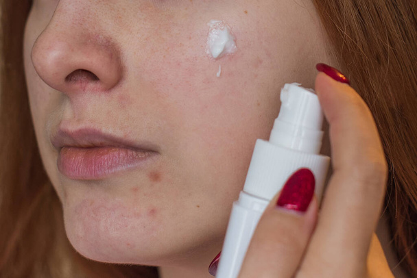 Acne and scars, simple woman close up natural portrait, No makeup and retouch. Problem skin - Foto, Imagem
