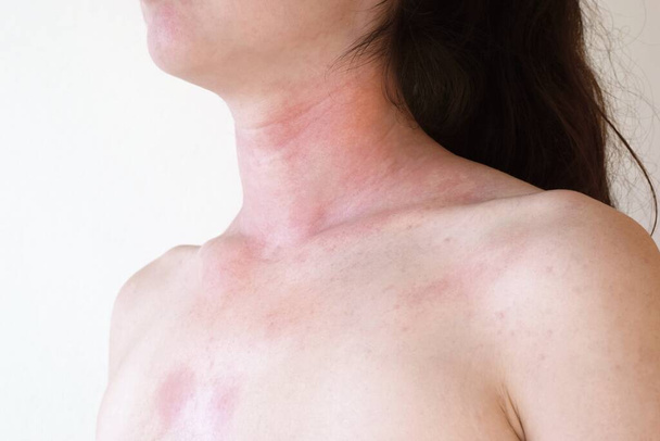 Allerginen ihoreaktio naisen niskassa ja rinnassa  - Valokuva, kuva