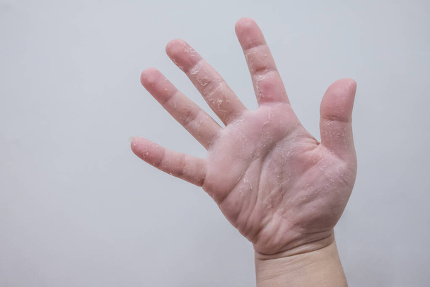 This image shows hands peeling caused by vitamin A deficiency. - Zdjęcie, obraz