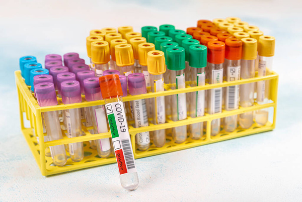 Laboratório preparando sangue teste para detecção de anticorpos e infecções vírus Corona. Tubo de ensaio com amostra de sangue para o teste do vírus SARS-CoV-2 ou COVID-19
 - Foto, Imagem