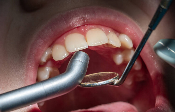 Dişçi randevusundaki çocuk. Çocuğun ağzının ve dişlerinin incelenmesi. - Fotoğraf, Görsel