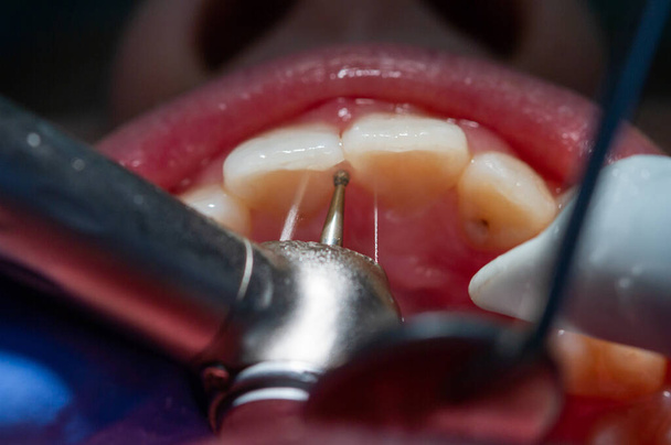 Dişçi randevusundaki çocuk. Çocuğun ağzının ve dişlerinin incelenmesi. - Fotoğraf, Görsel