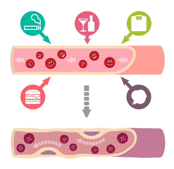 Иллюстрация того, что здоровая кровь становится грязной из-за различных нездоровых факторов, вызывающих атеросклероз
 - Вектор,изображение