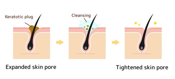 Illustration de la structure des pores / Bouchon kératotique clair (points blancs, points noirs) avec nettoyage. - Vecteur, image