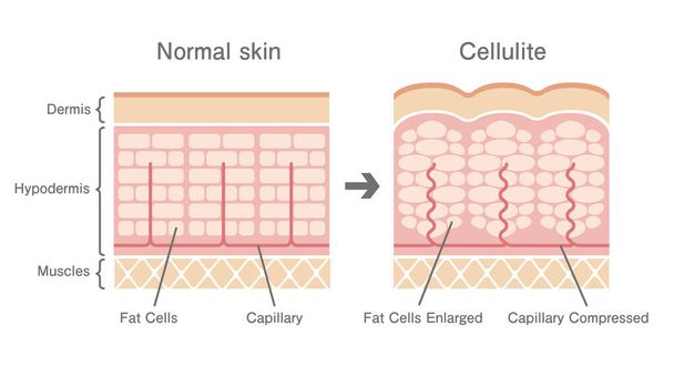 Porównawcza ilustracja normalnej skóry i skóry cellulitu - Wektor, obraz