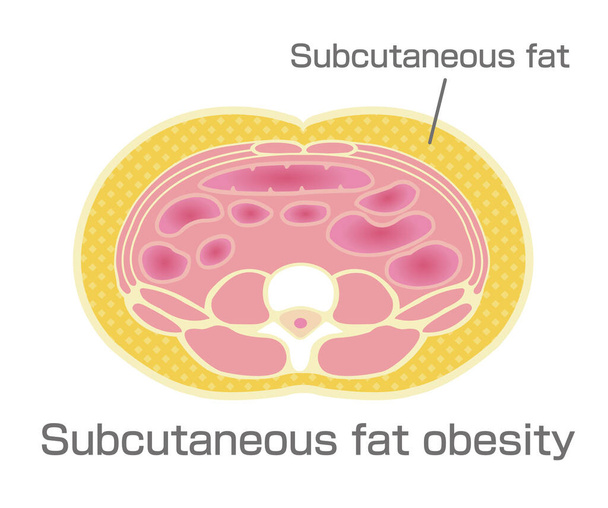 Τύπος απεικόνισης παχυσαρκίας. Κοιλιακή τομή Προβολή (υποδόριο λίπος)). - Διάνυσμα, εικόνα
