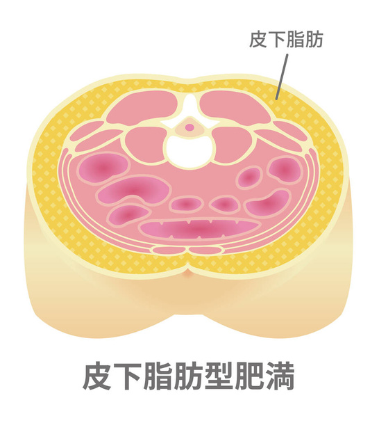 Type d'illustration de l'obésité. Vue de la section abdominale (graisse sous-cutanée). - Vecteur, image