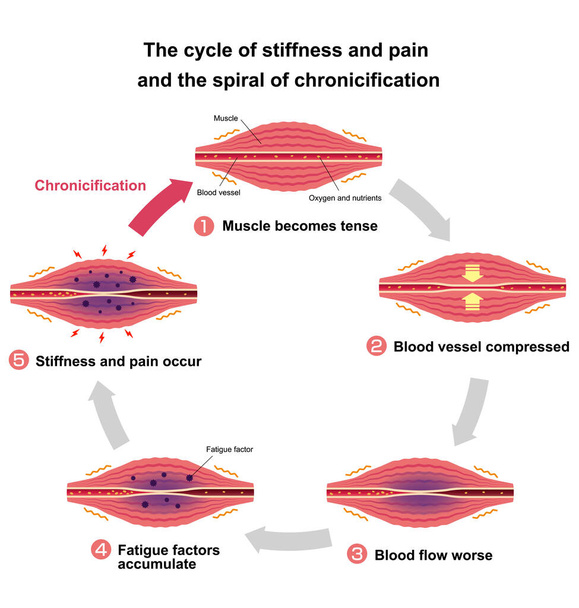 Cyklus ztuhlosti a bolesti a spirála chronikifikace ilustrace - Vektor, obrázek