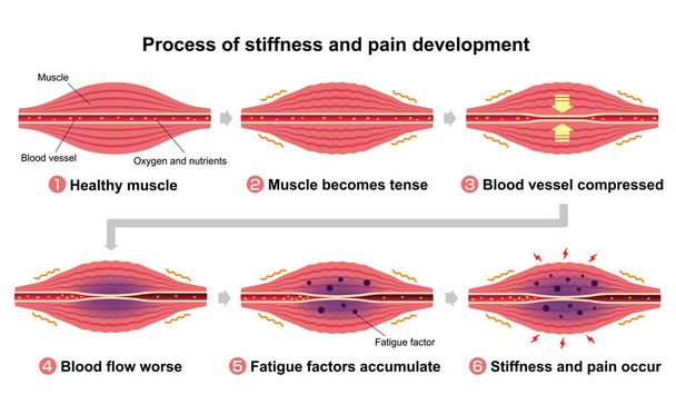 Иллюстрация жесткости и боли мышц (6 шагов
 ) - Вектор,изображение