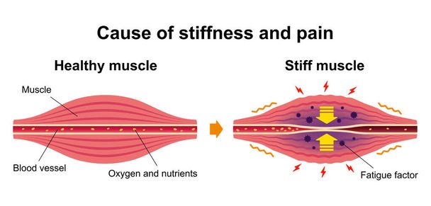 Cause of muscle's stiffness and pain illustration - Vector, Image