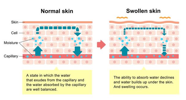 Srovnání ilustrace normální kůže a oteklé kůže - Vektor, obrázek