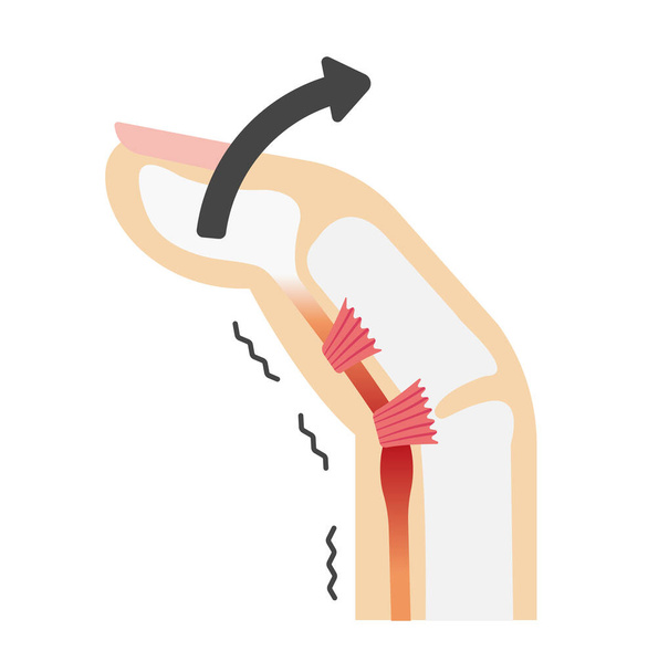 Causas y síntomas del dedo desencadenante ilustración / sin texto
 - Vector, imagen