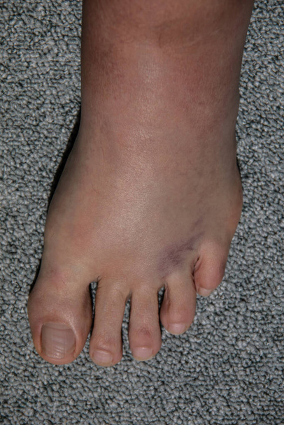 inflamación severa y hematoma del pie izquierdo después de doblarse y estiramiento del ligamento
 - Foto, imagen