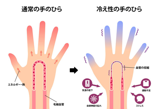 Comparação ilustração de mão normal e mão fria (sensibilidade ao frio, pontas dos dedos frias) / Japonês
 - Vetor, Imagem