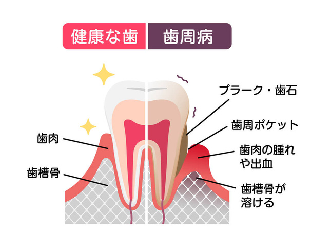 Comparison of normal teeth and periodontal disease. flat vector illustration - Vector, Image