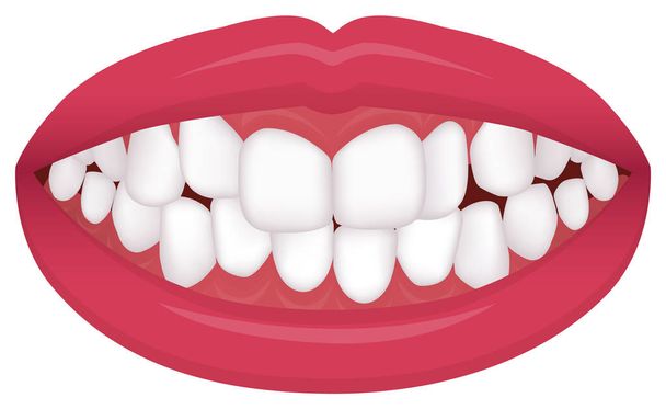 Проблемы с зубами (тип укуса / кривые зубы)
 - Вектор,изображение