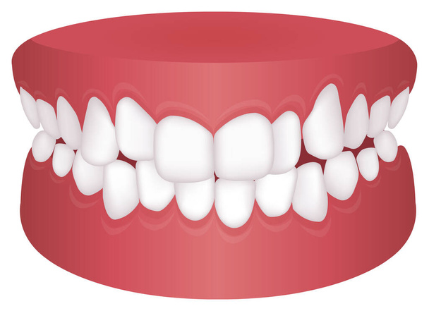 Teeth trouble ( bite type ) vector illustration /Crowding - Vektor, obrázek