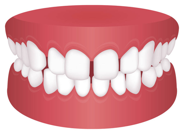 Problemas dentales (tipo de mordida) ilustración vectorial / / Espaciado excesivo
 - Vector, imagen