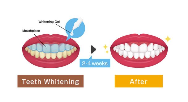 Illustrazione vettoriale di sbiancamento dei denti / prima e dopo - Vettoriali, immagini