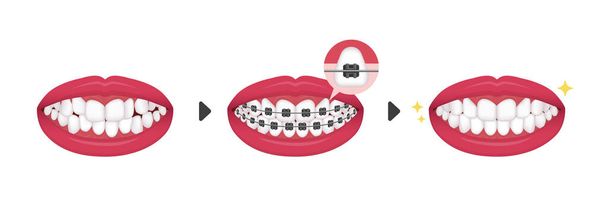 Dental braces process vector illustration / no text - Vector, Image