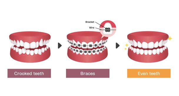 Процес зубних дужок Векторні ілюстрації
  - Вектор, зображення