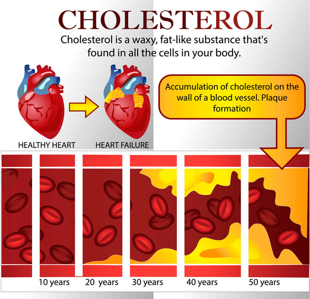 Kalp krizi ve atheroskleroz tıbbi illüstrasyon: sağlıklı ve hasarlı kalp, yağ birikimi olan kan damarı bölümü - Vektör, Görsel
