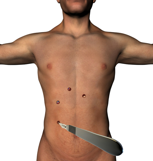 Laparoscopy surgery abdomen cut holes scalpel human body - Zdjęcie, obraz