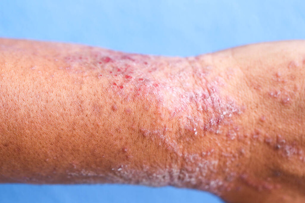 Atopic dermatitis (AD), also known as atopic eczema, is a type of inflammation of the skin (dermatitis). - Photo, Image