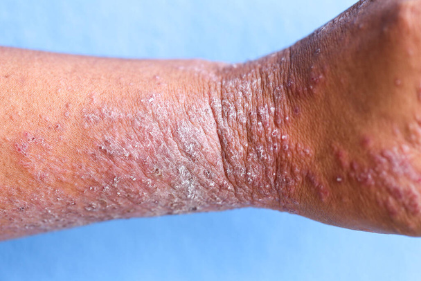 Atópiás dermatitis (AD), más néven atópiás ekcéma, egyfajta gyulladás a bőr (dermatitis). - Fotó, kép